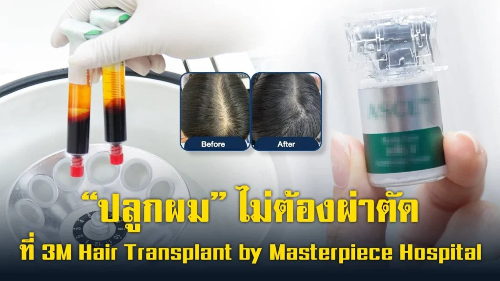 non-surgical-hair-transplant-no-recovery