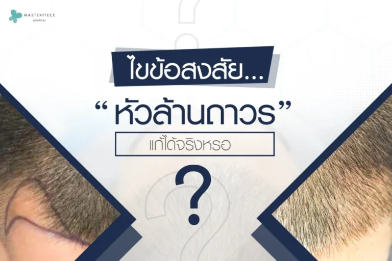 ไขข้อสงสัย…“หัวล้านถาวร” แก้ได้จริงหรอ ?