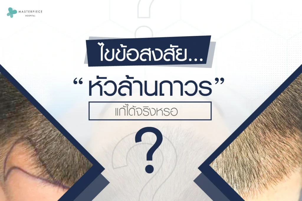 ไขข้อสงสัย…“หัวล้านถาวร” แก้ได้จริงหรอ ?