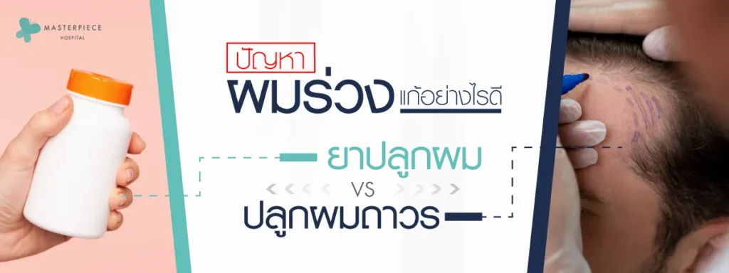 ปัญหาผมร่วงแก้อย่างไรดีระหว่างยาปลูกผม-vs-ปลูกผมถาวร