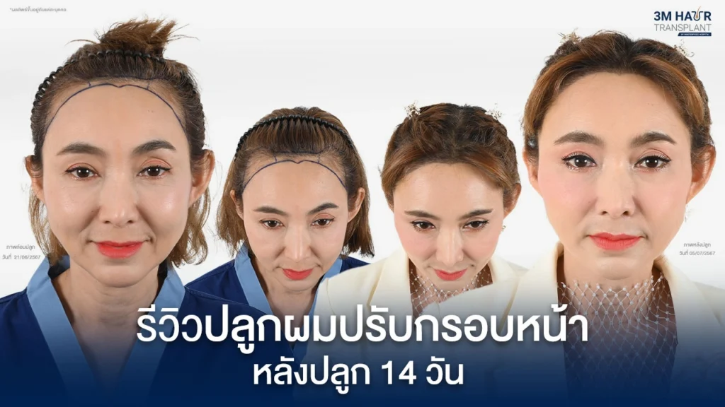 รีวิวปลูกผมปรับกรอบหน้าหลังปลูกผม 14 วัน