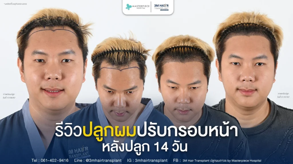 รีวิวปลูกผมปรับกรอบโครงหน้า ของ youtube เมืองไทย