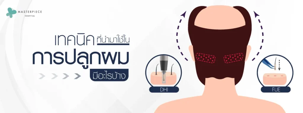 เทคนิคที่นำมาใช้ในการปลูกผมมีอะไรบ้าง-14-02-2566